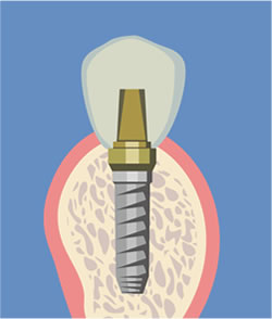 インプラント