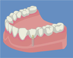 インプラントの利点